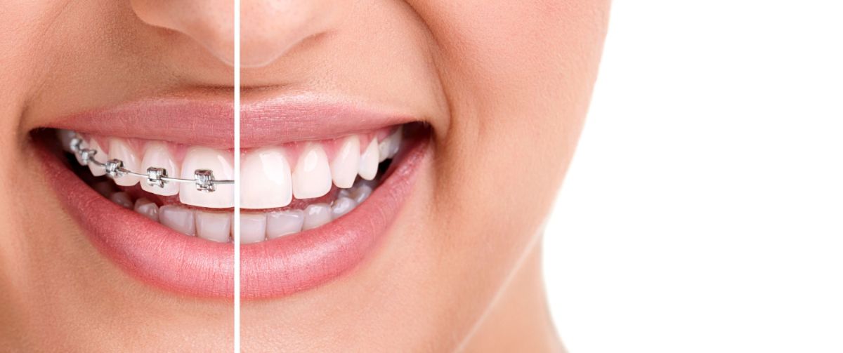 Invisalign or Braces: Which Treatment Option Is Right For Me?