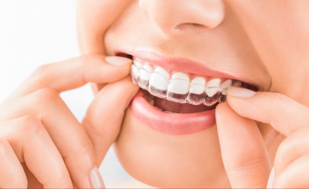 Woman inserting Invisalign clear aligner into her mouth, showcasing a comfortable and discreet orthodontic solution for straighter teeth.