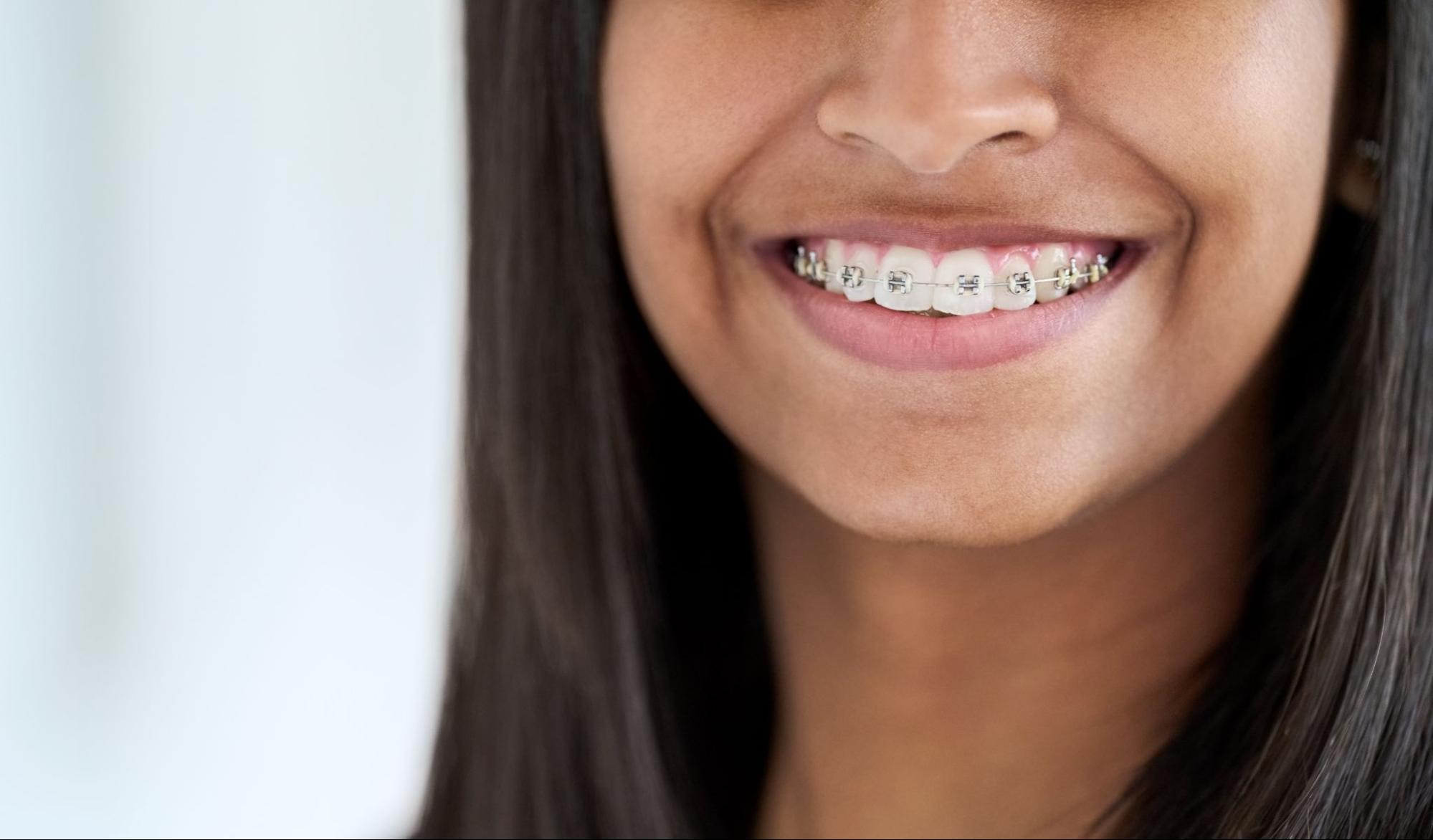 Can Braces Help With TMJ Issues?